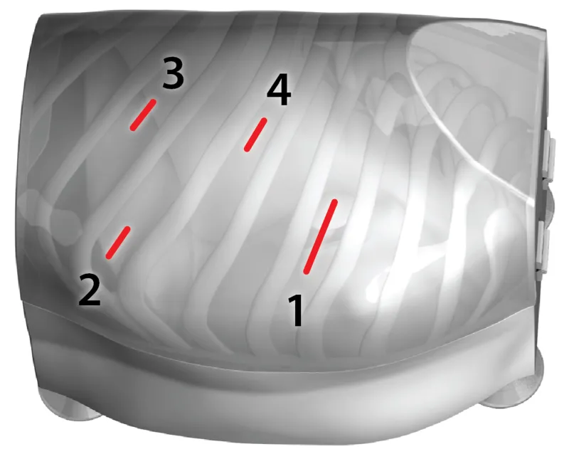 Standard locations of access incisions