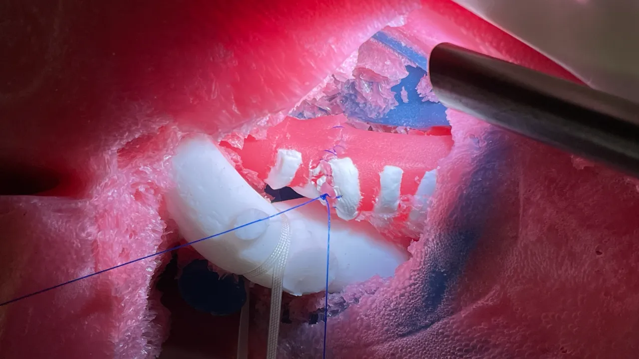 Thoracoscopic surgical procedure in progress